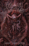 Vulvectomy - Aberrant Vaginal Gestation Tape